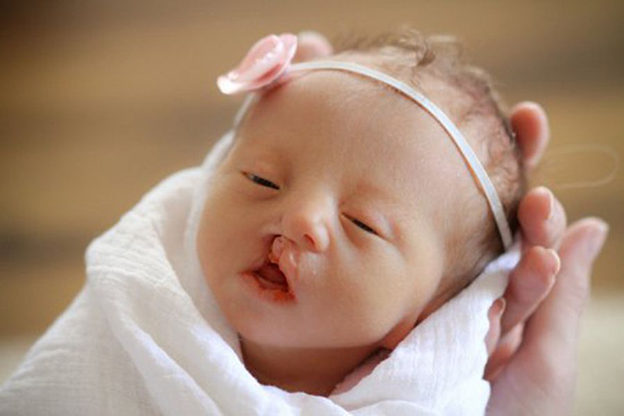 Hội chứng Patau (Trisomy 13)