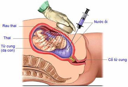 phương pháp chọc ối