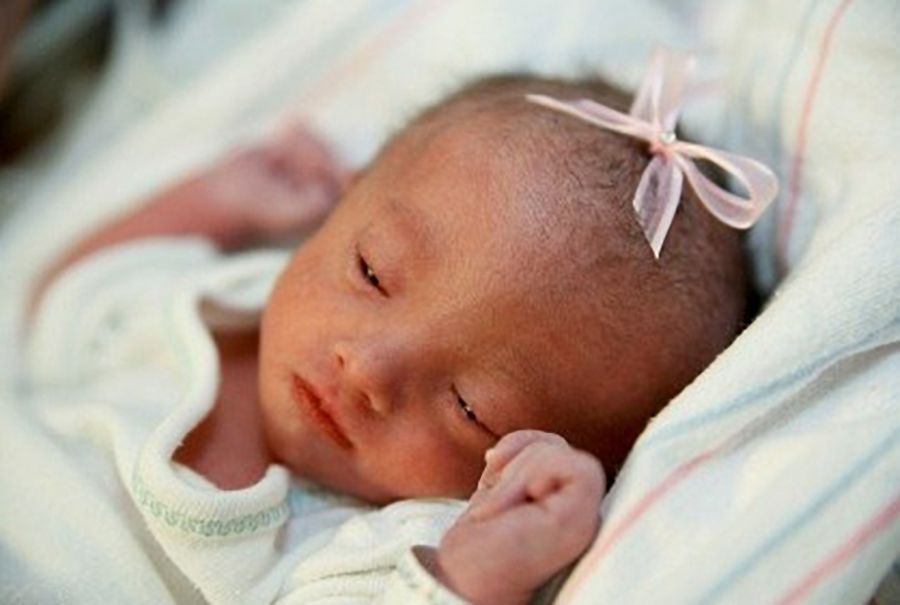 Hội chứng Edwards (Trisomy 18)