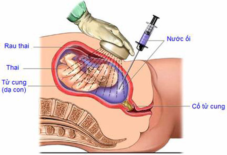 phương pháp chọc ối