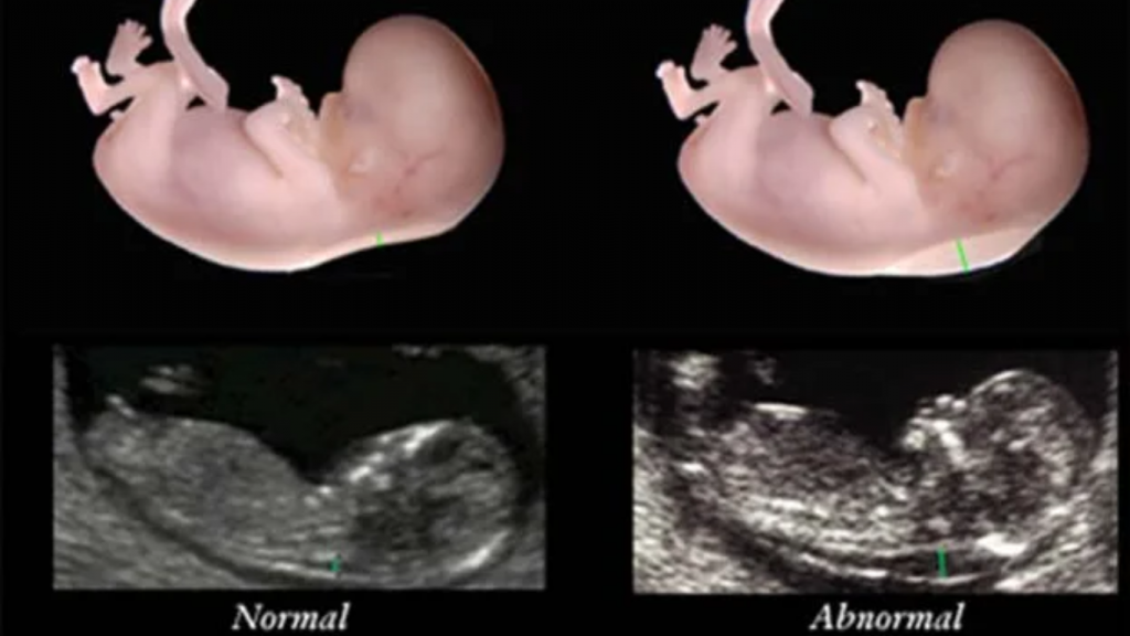 hình ảnh siêu âm thai 11 tuần tuổi