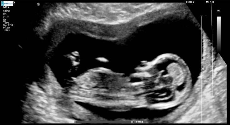 Hình ảnh siêu âm thai 13 tuần