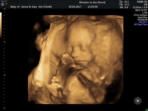 Hình ảnh siêu âm thai 24 tuần