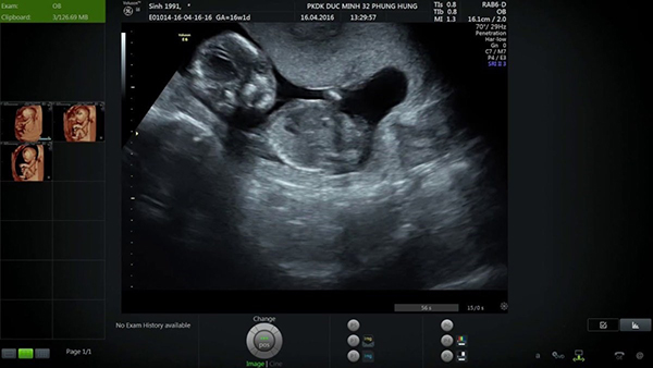 hình ảnh siêu âm thai 16 tuần
