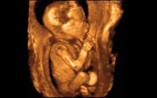 hình ảnh siêu âm thai 18 tuần