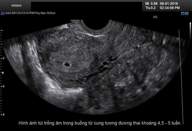 Hình ảnh siêu âm thai 5 tuần tuổi